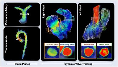 Direct comparison of whole heart quantifications between different retrospective and prospective gated 4D flow CMR acquisitions